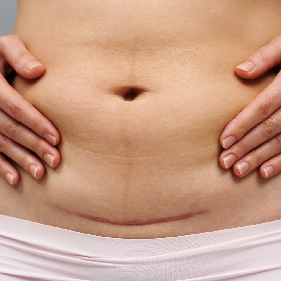 Navishqa - Normal Delivery and Cesarean Section