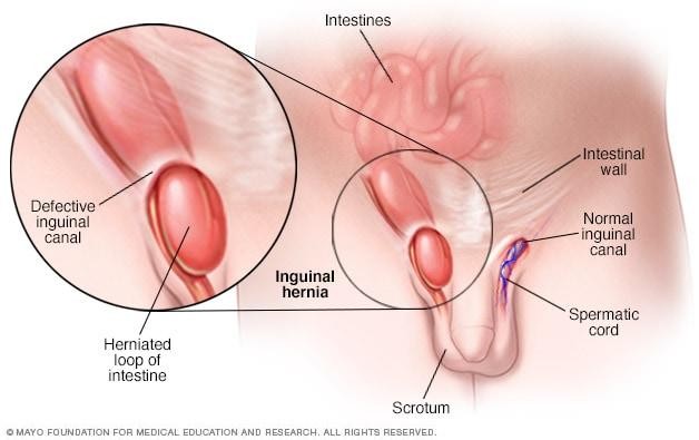laparoscopic hernia surgery kids