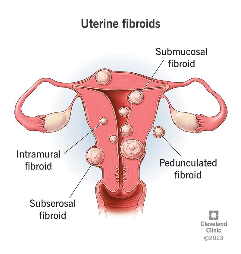 Fibroid specialist in Bengaluru