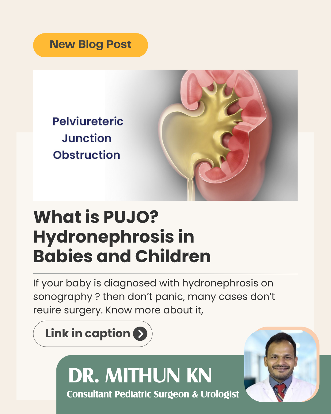 Hydronephrosis Treatment in Babies in Bengaluru - Dr Mithun KN